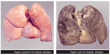 Sigarann Solunum Sistemine Etkileri